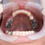 Rubber Dam (Lastik Örtü) Uygulaması